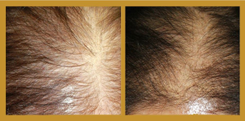 Best Supplements for Hair Growth | Smart Restoration